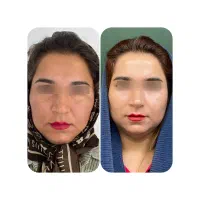 بوتاکس،فیلر، ژل ،ریموو تتو|خدمات زیبایی و سلامت|کرمانشاه, |دیوار