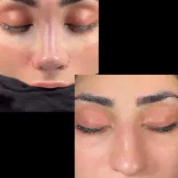 ساکشن غبغب تزریق چربی جراحی عمل بینی بایپس|خدمات آرایشگری و زیبایی|تهران, صادقیه|دیوار
