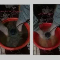 سم زدایی درمان دررفتگی ناف وهولگیری.و مفاصل