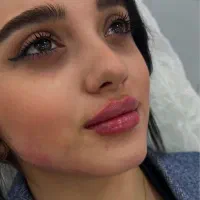 تزریق ژل فیلر/بوتاکس/prp پوست مو/پی آر پی/مزوتراپی|خدمات آرایشگری و زیبایی|کرج, گوهردشت|دیوار