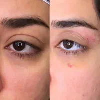 جشنواره پاییزه بلفاروپلاستی