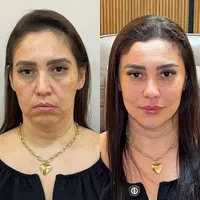 تزریق ژل و بوتاکس طراحی چهره برای زیبایی‌خاص|خدمات آرایشگری و زیبایی|تهران, شادمان|دیوار