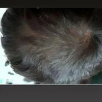 درمان ریزش مو