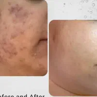 ده سال جوانتر شوید ،بایولیفت راه حل شما