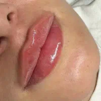 تزریق فیلر و بوتاکس با آف ویژه