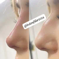 آموزش و خدمات تخصصی فیلر وبوتاکس|خدمات آموزشی|شیراز, معالی‌آباد|دیوار