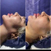 ساکشن تزریق