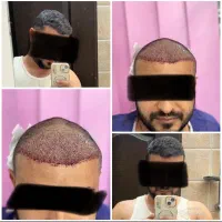 کاشت مو شیراز