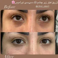 تزریق ژل و بوتاکس و پی ارپی و مزوتراپی و لیزر مو|خدمات آرایشگری و زیبایی|بوشهر, |دیوار