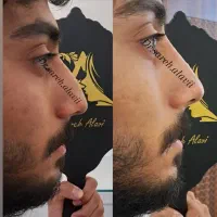 اصلاح فرم بینی بدون جراحی و بیهوشی توسط پزشک|خدمات آرایشگری و زیبایی|قم, دورشهر|دیوار