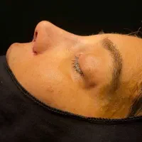 عمل زیبایی بینی