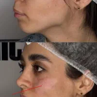 جشنواره ژل و بوتاکس توسط پزشک|خدمات آرایشگری و زیبایی|کرمانشاه, |دیوار
