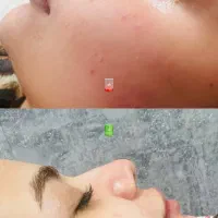 فشیال درمان جوش ولک وچین هو چروک