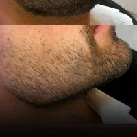 جشنواره تخفیفی ژل و بوتاکس/وام/اقساطی|خدمات آرایشگری و زیبایی|ساری, |دیوار