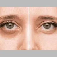 وایتنینگ و رفع تیرگی نواحی بدن