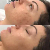 ضد لک قوی برای پوستی صاف، شفاف و یکدست