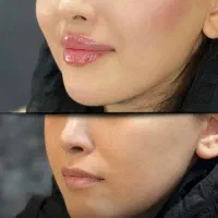 تزریق چربی ژل بوتاکس|خدمات آرایشگری و زیبایی|خرم‌آباد, |دیوار