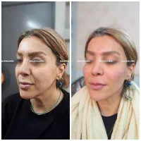 جشنواری تخفیفی کلینیک زیبایی دالیا (فیلر و بوتاکس)|خدمات زیبایی و سلامت|تهران, فدک|دیوار