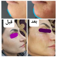 تخفیف بوتاکس، ژل، مزوژل، پی آر پی توسط پزشک