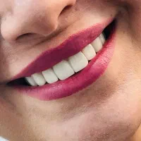 دندان مصنوعی، دندانسازی، دندان طرح لمینت 40%تخفیف|آرایشی، بهداشتی، درمانی|مشهد, مصلی (کارمندان اول)|دیوار