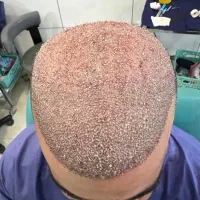 کاشت تخصصی مو و ابرو به صورت نقد و اقساط