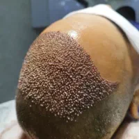 کاشتمو روش میکروگرفت بدون ورم بالاترین تراکم