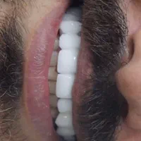 روکش زیرکونیا/ایمپلنت کره ای/ونیر|خدمات آرایشگری و زیبایی|بابل, |دیوار