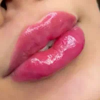 ژل و بوتاکس