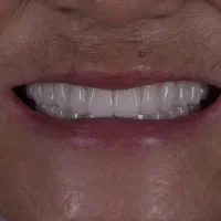 دندانسازی (تحویل فوری 1روزه بدون لقی ) نقد و اقساط|خدمات زیبایی و سلامت|اصفهان, کوی ولی عصر|دیوار