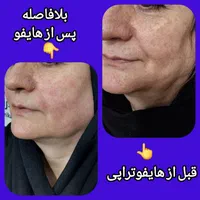 ** جوانسازی پوست با هایفو تنها ۹۸۰ هزار **|خدمات آرایشگری و زیبایی|تهران, نازی‌آباد|دیوار