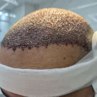 اموزش کاشت فقط ۲ نفر