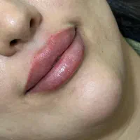 تزریق ژل و بوتاکس و پی ارپی و مزوتراپی و لیزر مو