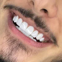 کامپوزیت دندان