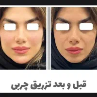 تزریق چربی فول فیس/ژل لب/لیفت با نخ/هیپ دیپ/بوتاکس