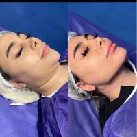 جشنواره ۵۰درصدی ژل و بوتاکس ، ساکشن غبغب|خدمات آرایشگری و زیبایی|کرمانشاه, |دیوار