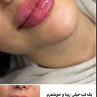 آف تزریق ژل وبوتاکس ومزومووصورت|خدمات آرایشگری و زیبایی|اهواز, نادری|دیوار