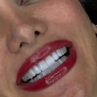 کامپوزیت/عصبکشی/ دندانپزشکی /اقساط