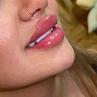 تزریق ژل و بوتاکس فقط۷۵۰