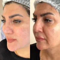 هایفو جوانساز و لیفت صورت