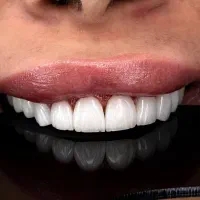 اجرای تخصصی کامپوزیت از ۷۰۰ هزار