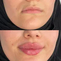 جشنوراه اقساطی ژل و بوتاکس با ضمانت بی قید و شرط|خدمات آرایشگری و زیبایی|تهران, میرداماد|دیوار