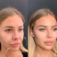 ژل لب ،زاویه سازی،فیلر چانه ،فول فیس|خدمات آرایشگری و زیبایی|مشهد, سجاد شهر|دیوار