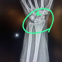 آموزش شکسته بندی و اصلاح مفاصل
