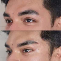 ژل وبوتاکس.افزایش سایزآلت آقا.لیفت بانخ توسط پزشک|خدمات آرایشگری و زیبایی|قم, صفائیه|دیوار
