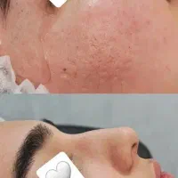 عمل بینی با بیحسی بلفاروپلاستی با بخیه زیر جلدی