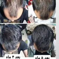 پک ریزش و رویش مجدد مو|آرایشی، بهداشتی، درمانی|تهران, فلاح|دیوار