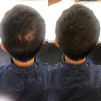 ریزش مو  رویش مجدد  ریزش موهای ارثی و هورمونی