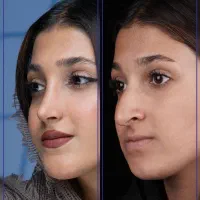 جراحی بینی با قیمت سال قبل +اقساط+مشاوره رایگان