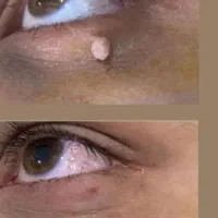 برداشتن خال زگیل کک ومک دونه چربی میخچه در یک جلسه