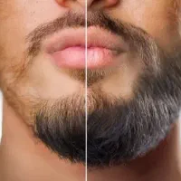 ریش سبیل ریزش سکه ای